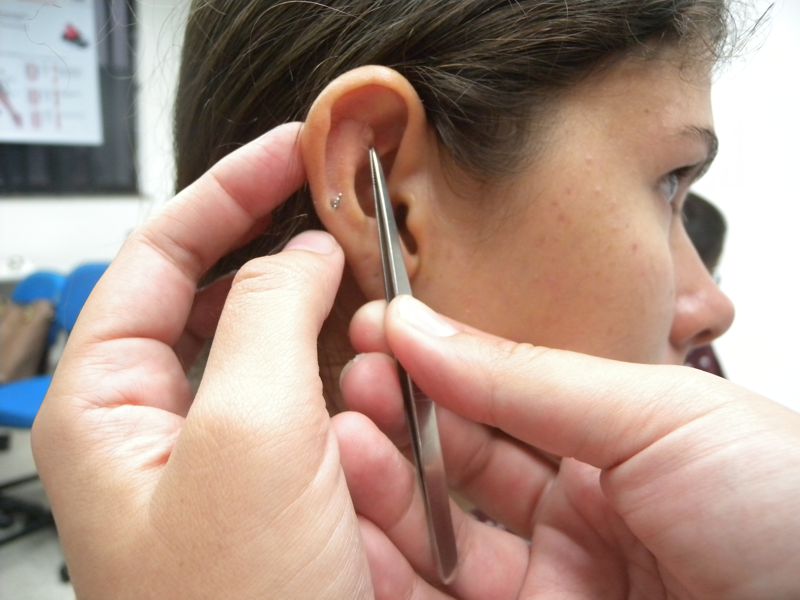 Acupuntura auricular: paciente recebe terapia